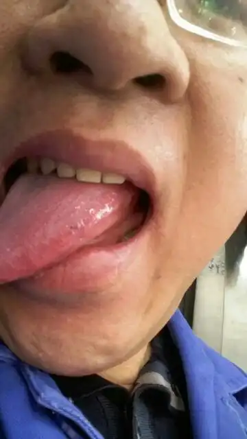 舌侧老是有条白线正常吗?是不是得病了